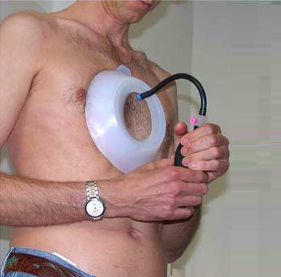 vacuum device therapy on indented chest