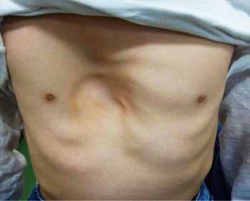 patient with asymmetric sunken chest